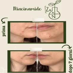 Niacinamide + Zinco