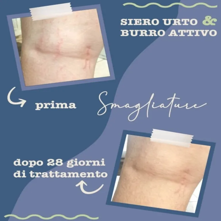 Siero Urto Smagliature